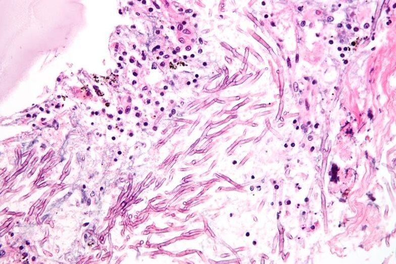 Pilze stören das Immunsystem und führen zur Bildung von Mykosen